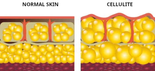 normalskin-cellulite